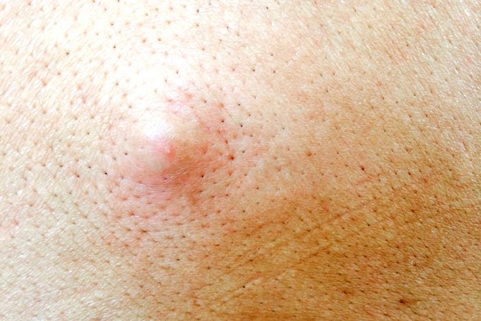 Skin bump.