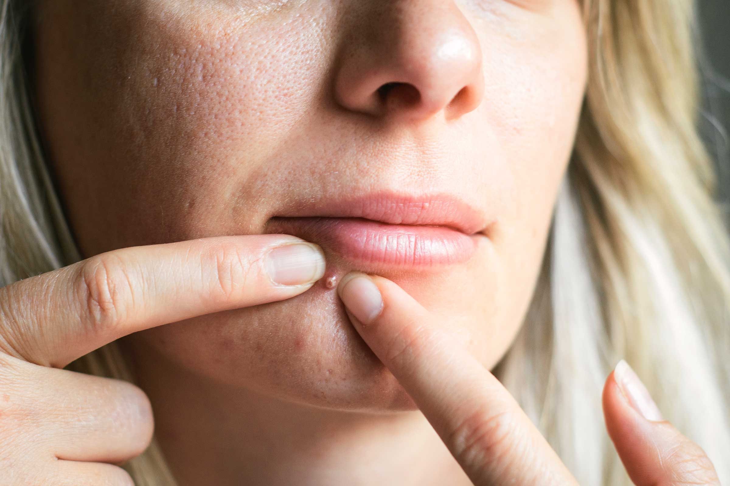 Woman with adult acne.