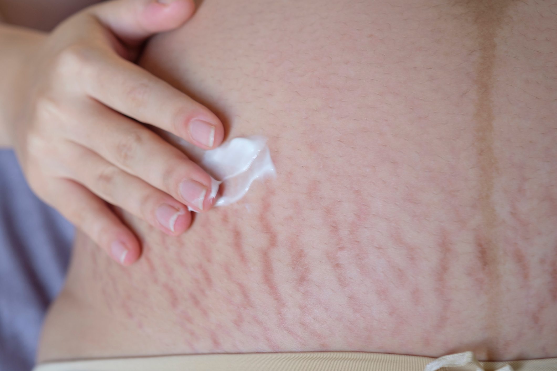 woman applying cream to stretch marks
