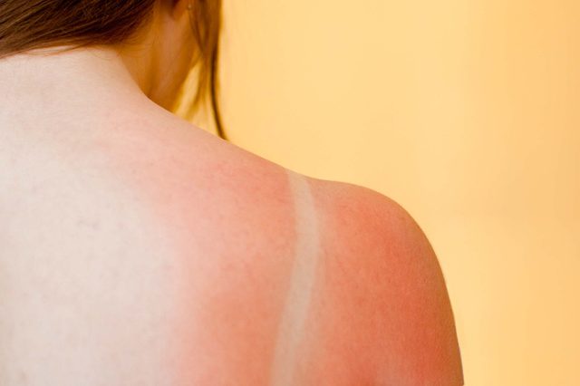 4_rash_silent_lupus_07photo
