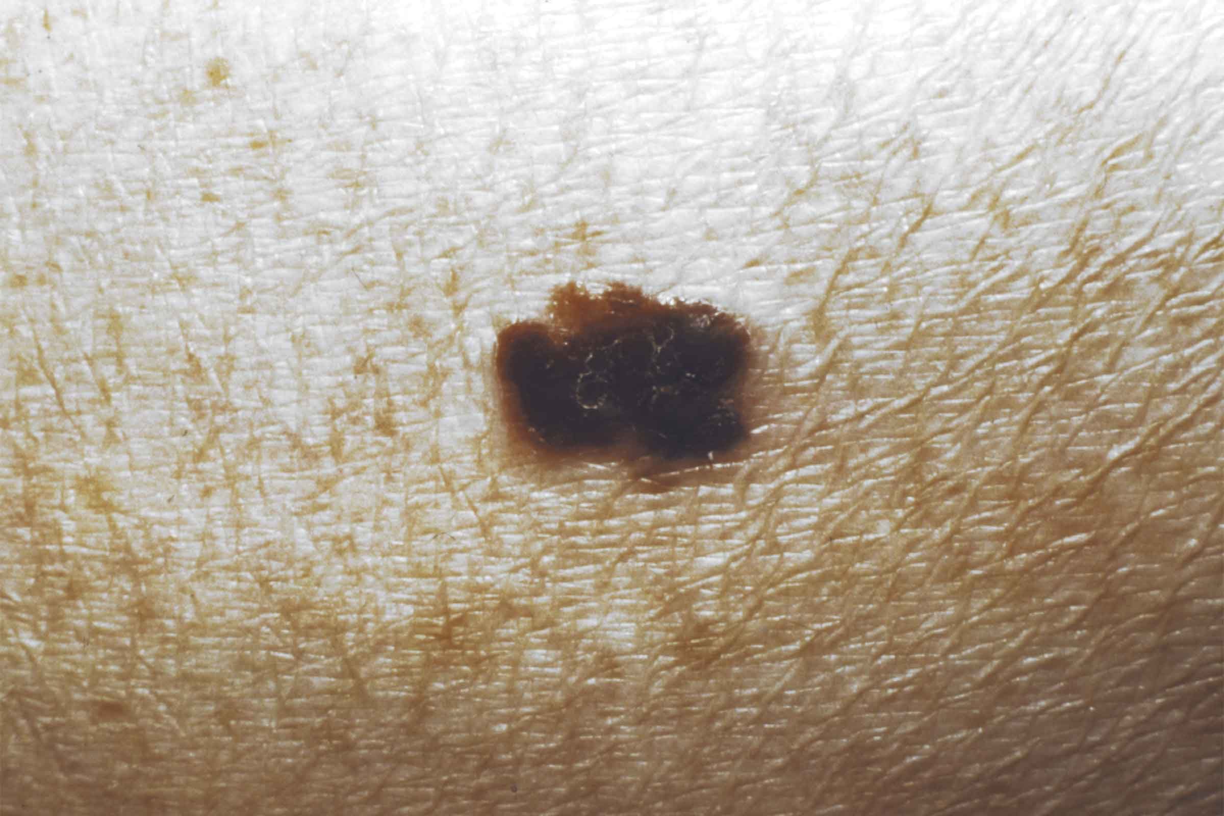 02-skin-cancer-moles