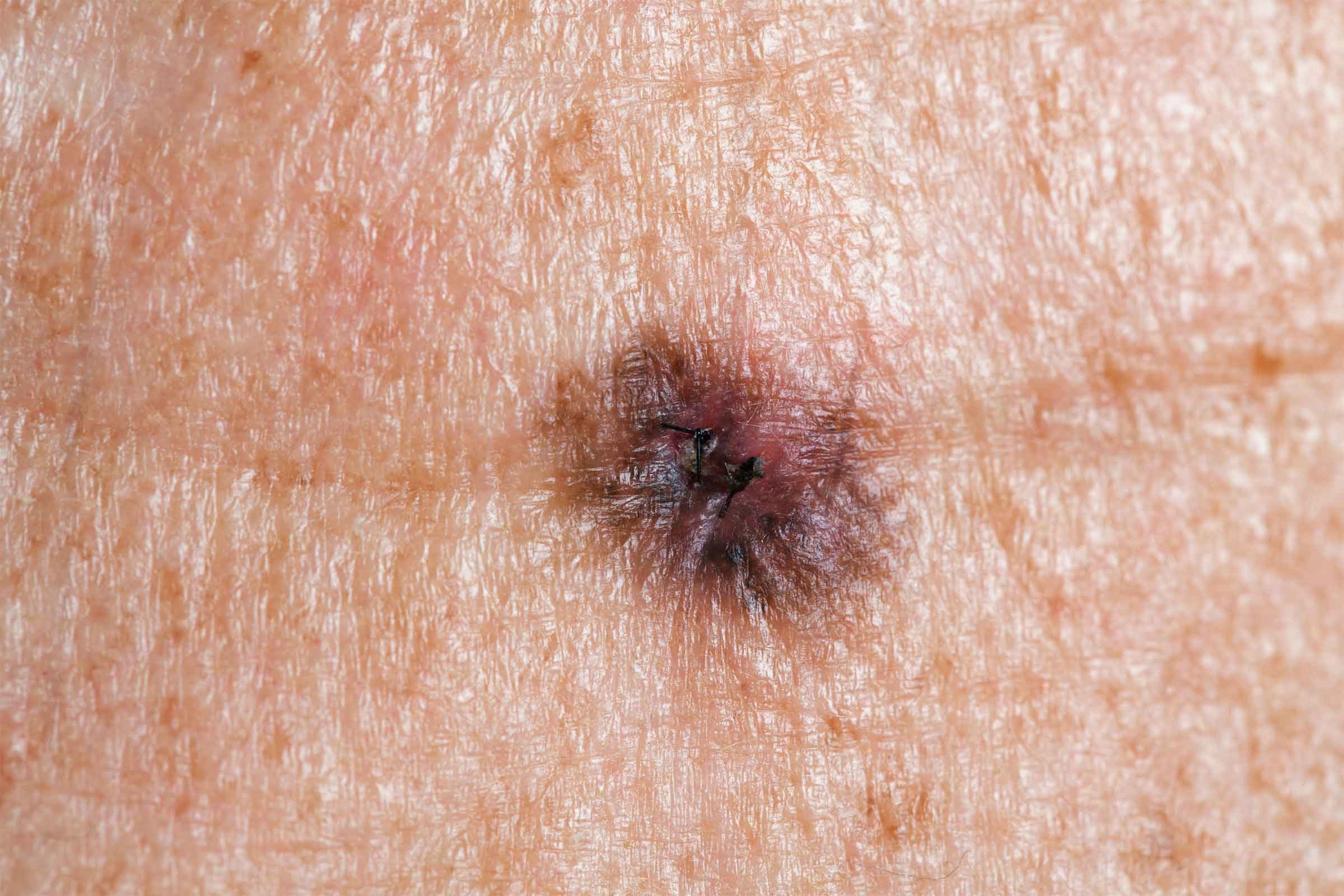 03-skin-cancer-moles