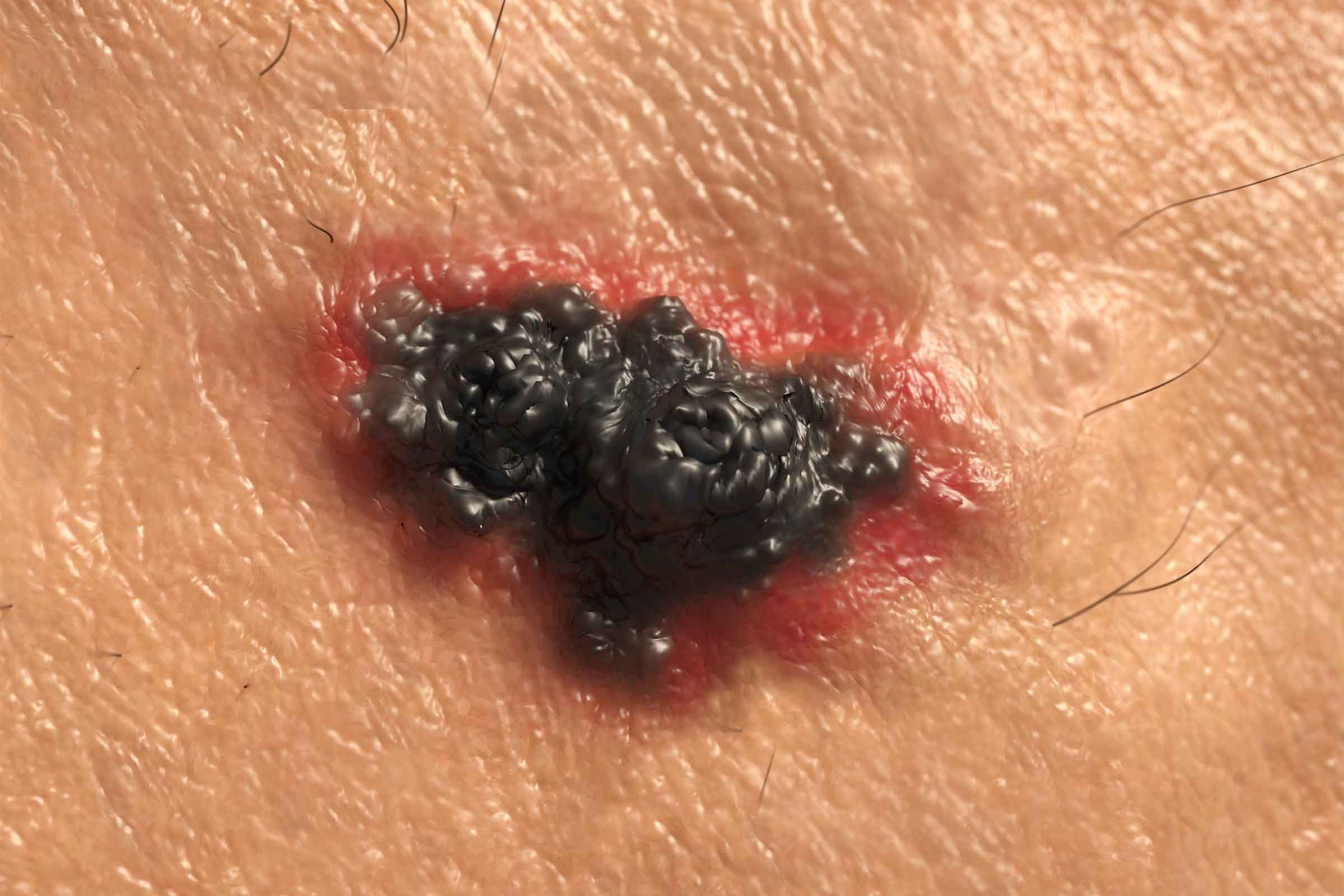 04-skin-cancer-moles