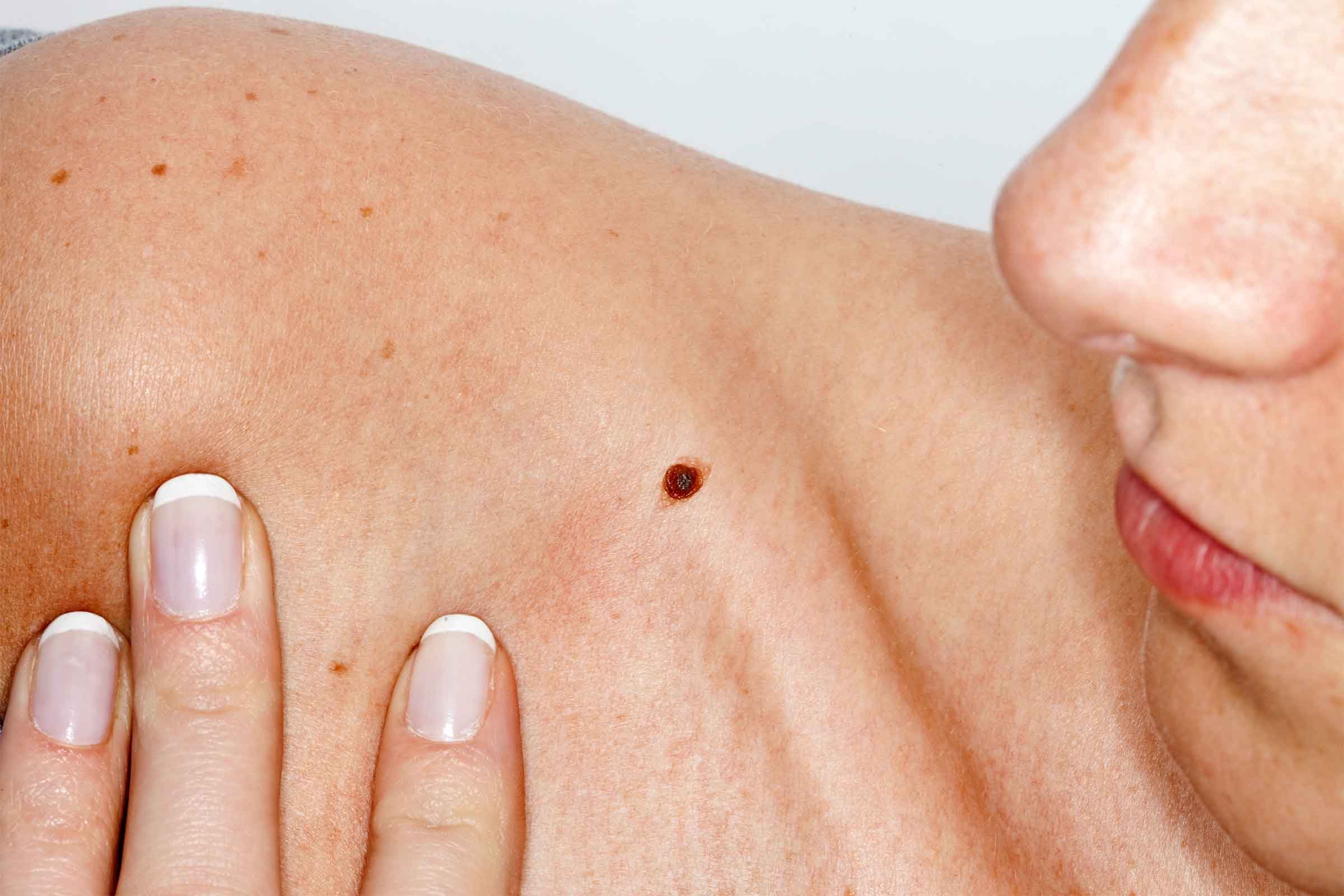 05-skin-cancer-moles