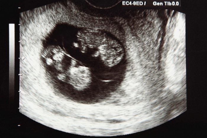 ultrasound of baby