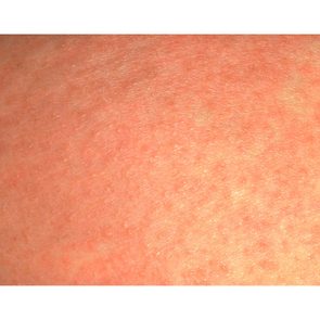 08-whats-that-rash-heat-rash