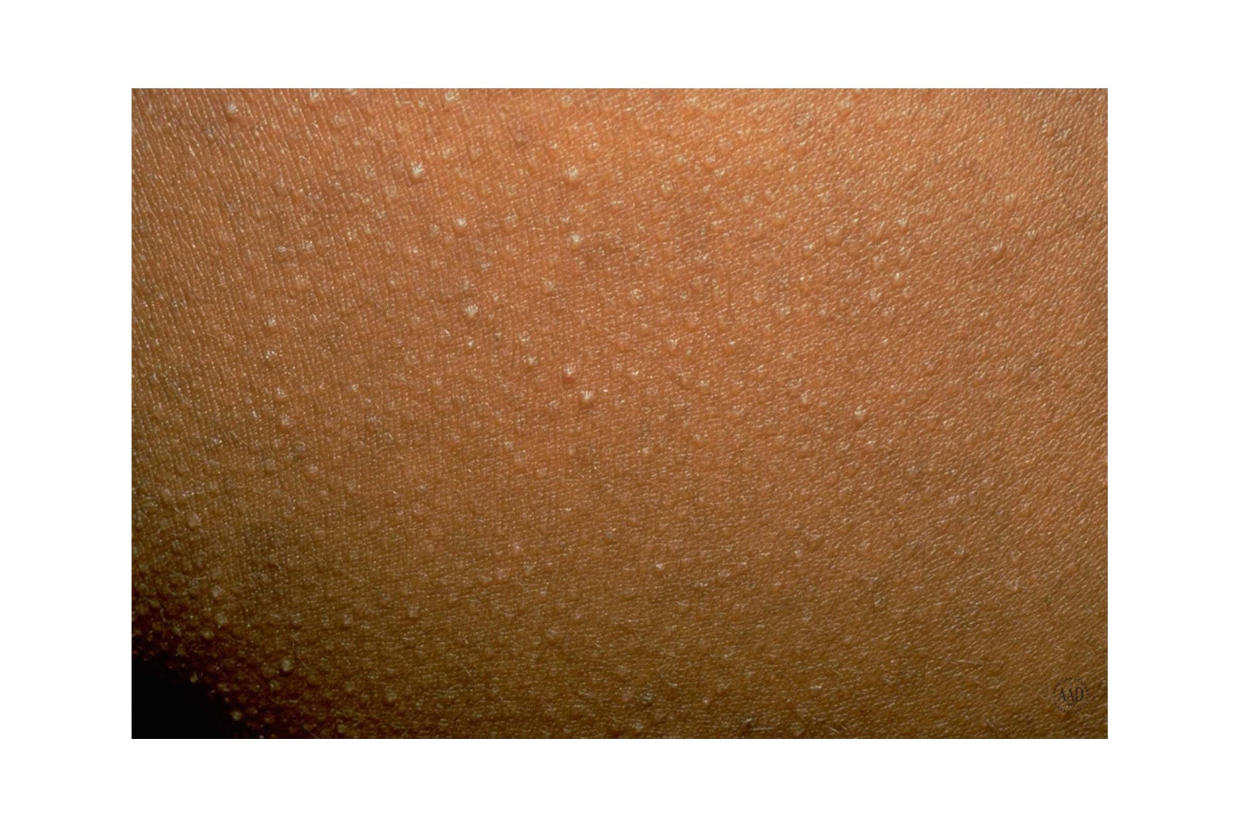 closeup of Keratosis pilaris bumps