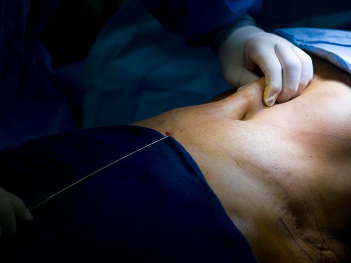 closeup of liposuction procedure on stomach