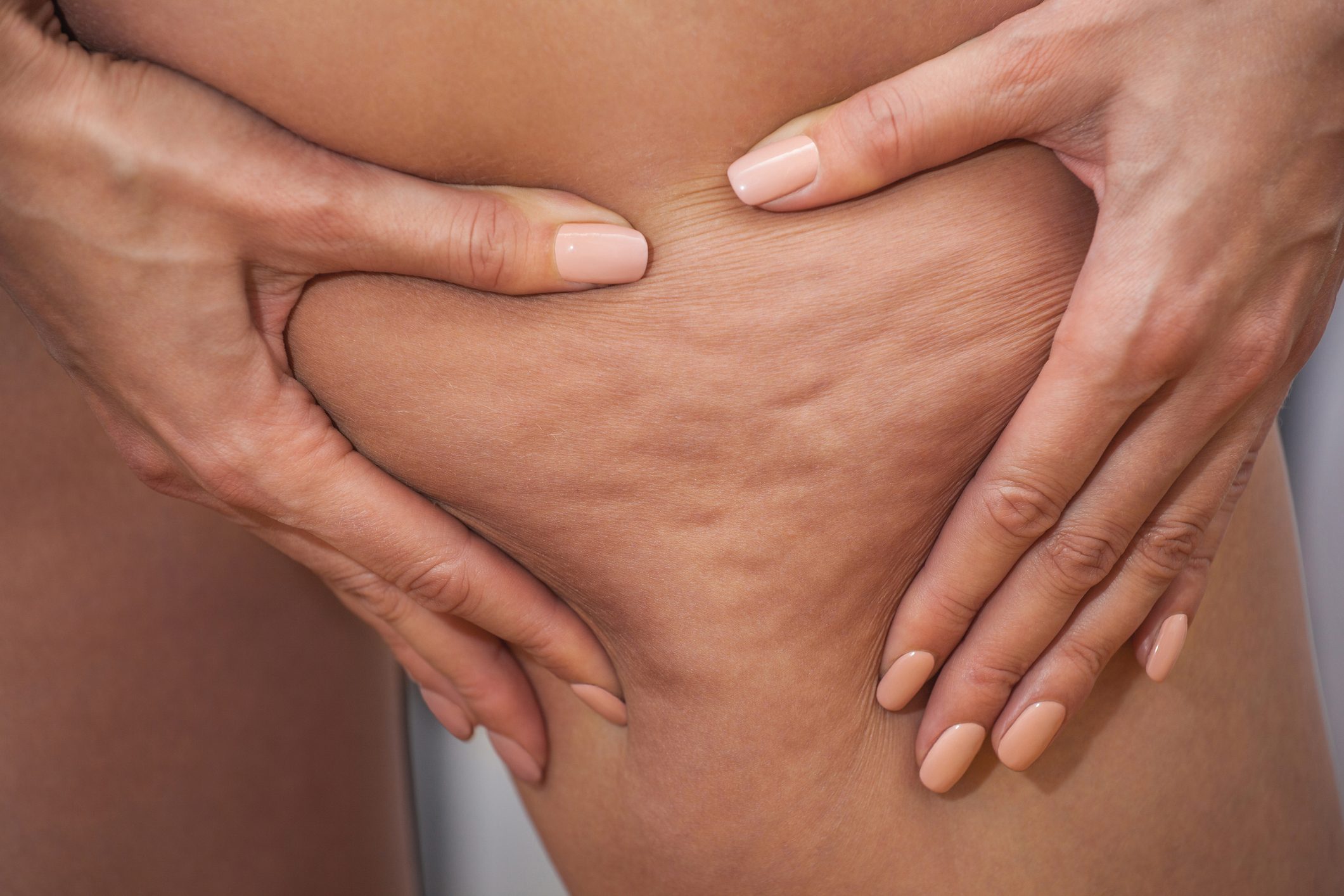 close up of cellulite on woman's leg