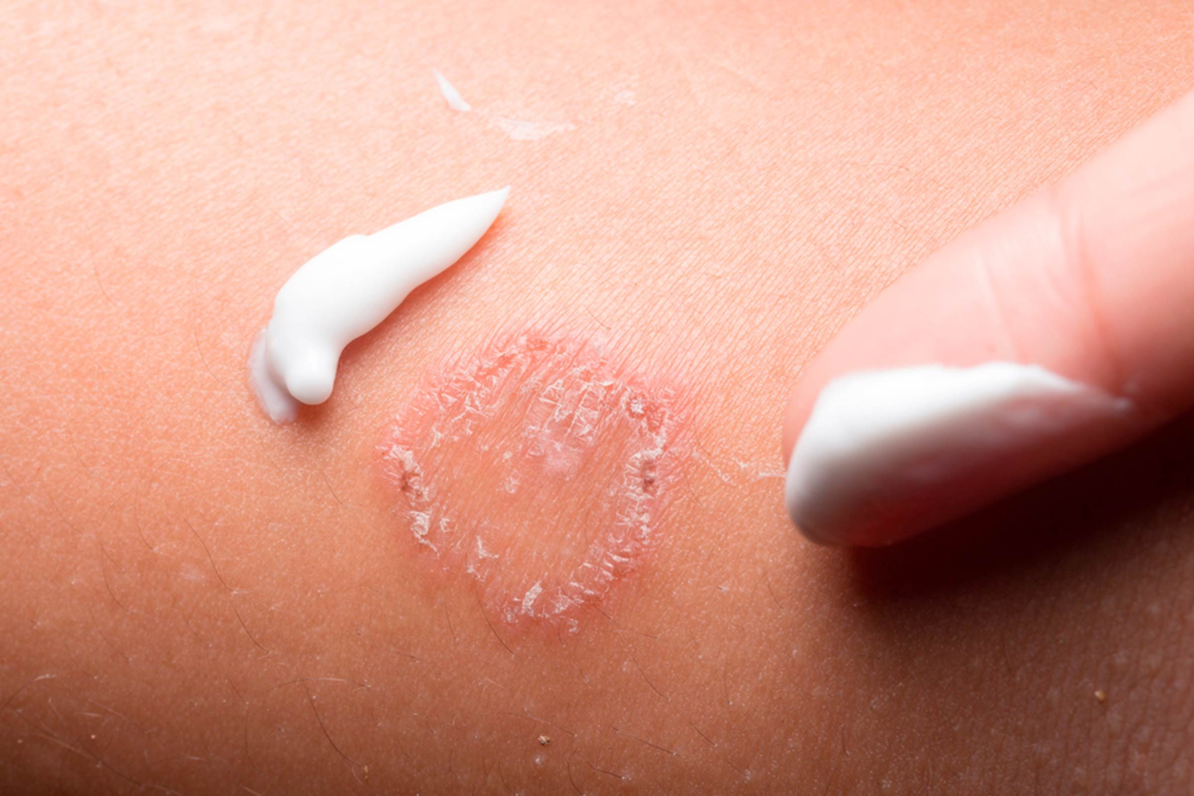 cream on skin irritation