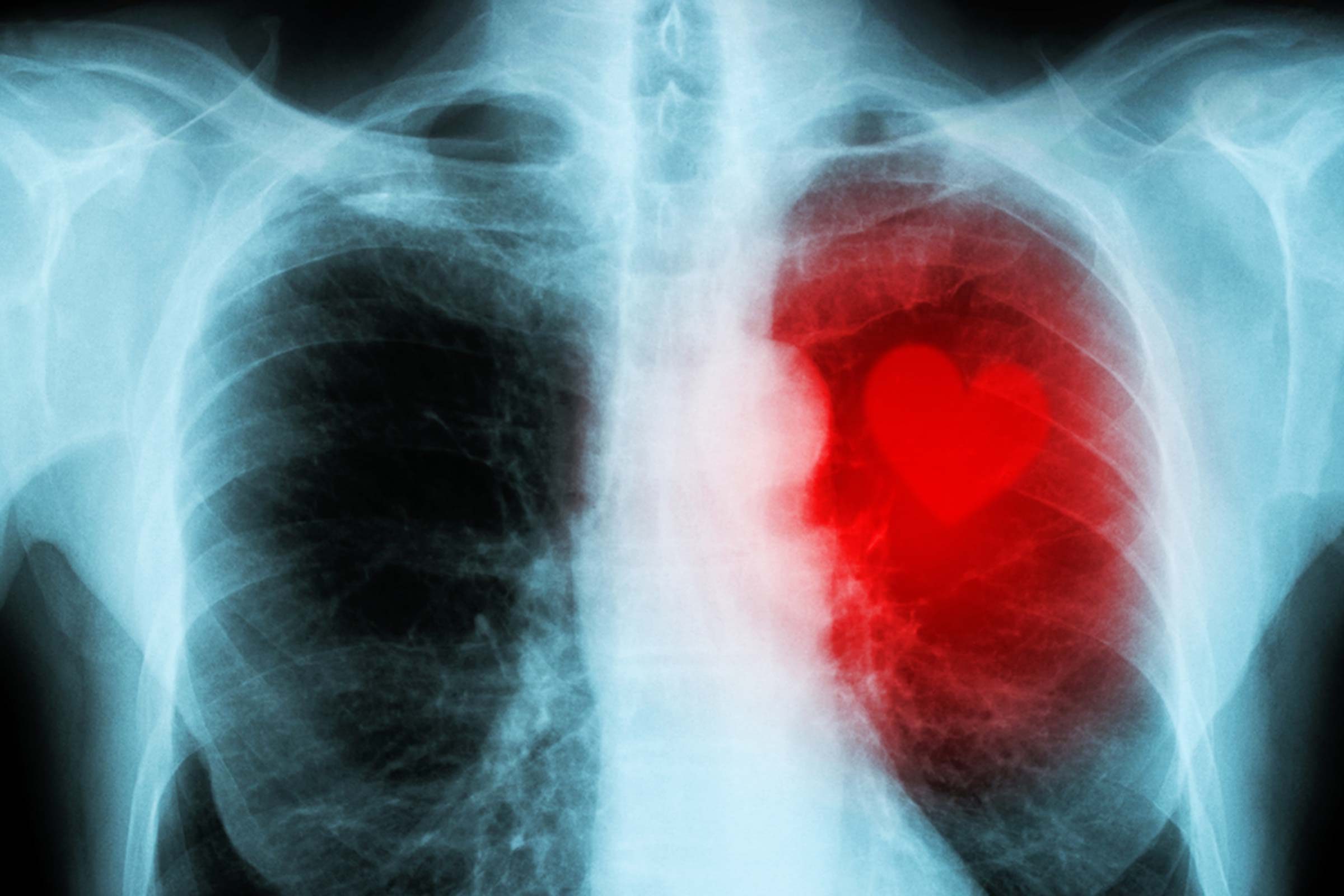 chest x-ray with illustration of heart