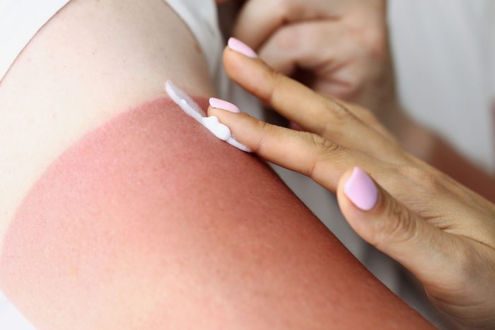 Woman's hand applies willow bark cream to burn to treat sunburn.