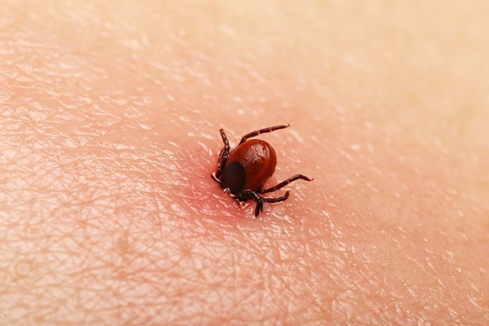 Tick halfway in skin, closeup
