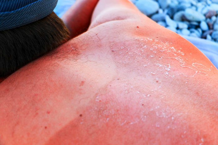 01-sunburn-How-to-Treat-Sunburn-With-Essential-Oils_441609742-Liubov-Silanteva