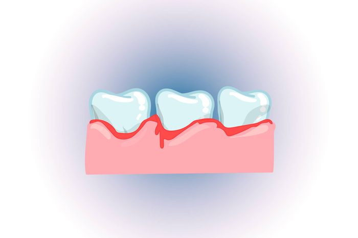 Illustration of three teeth bleeding in the gums, or an infection.