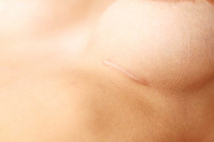 Scar under a breast.