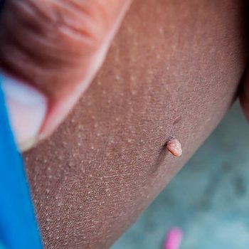 This-Is-the-ONLY-Way-You-Should-Remove-Skin-Tags,-According-to-a-Dermatologist-618768854-photosthai-FT