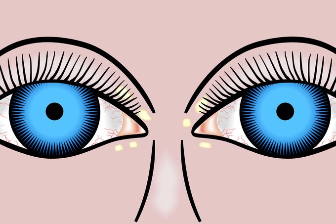 eyes with yellow spots