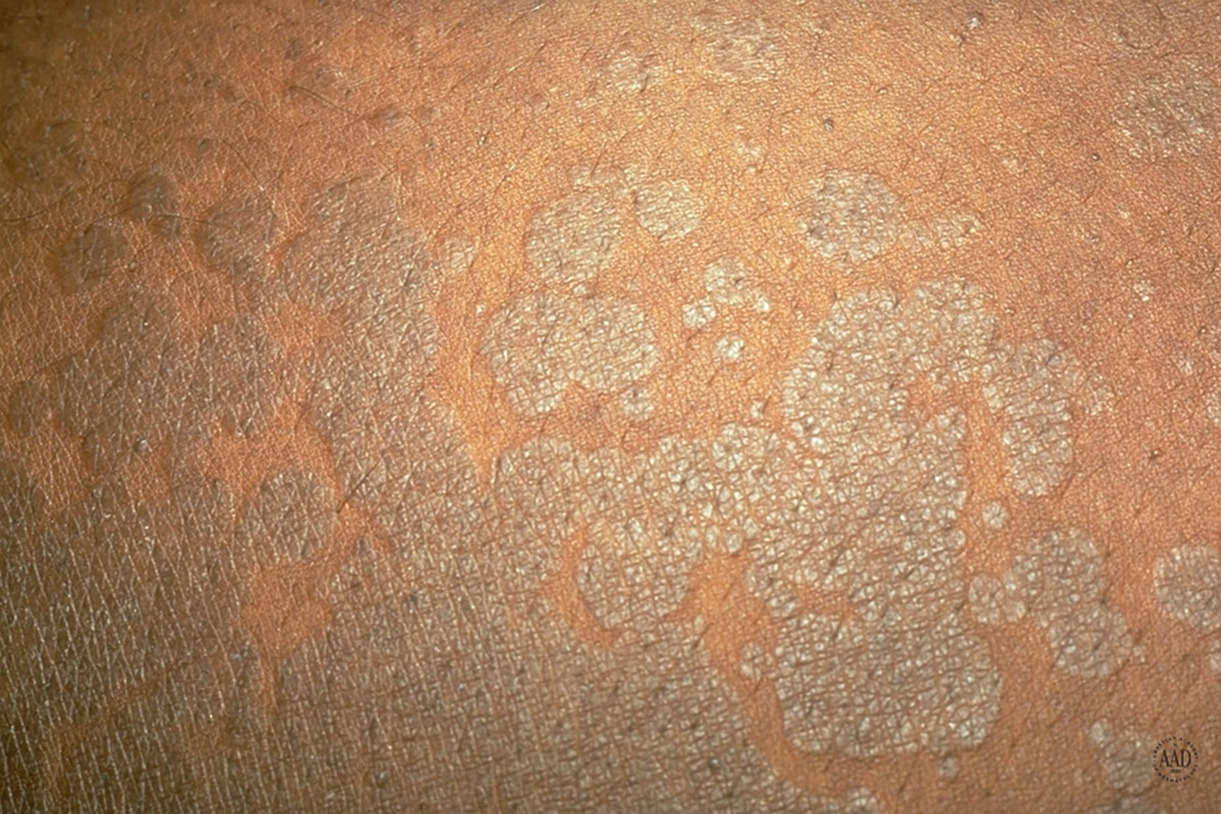 close up of pityriasis versicolor