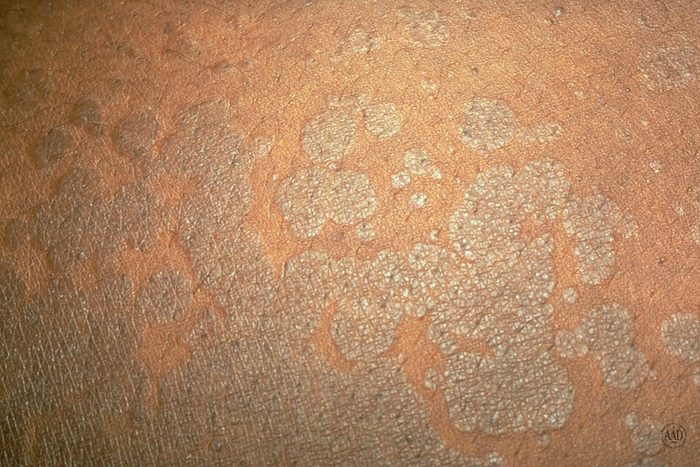 close up of pityriasis versicolor