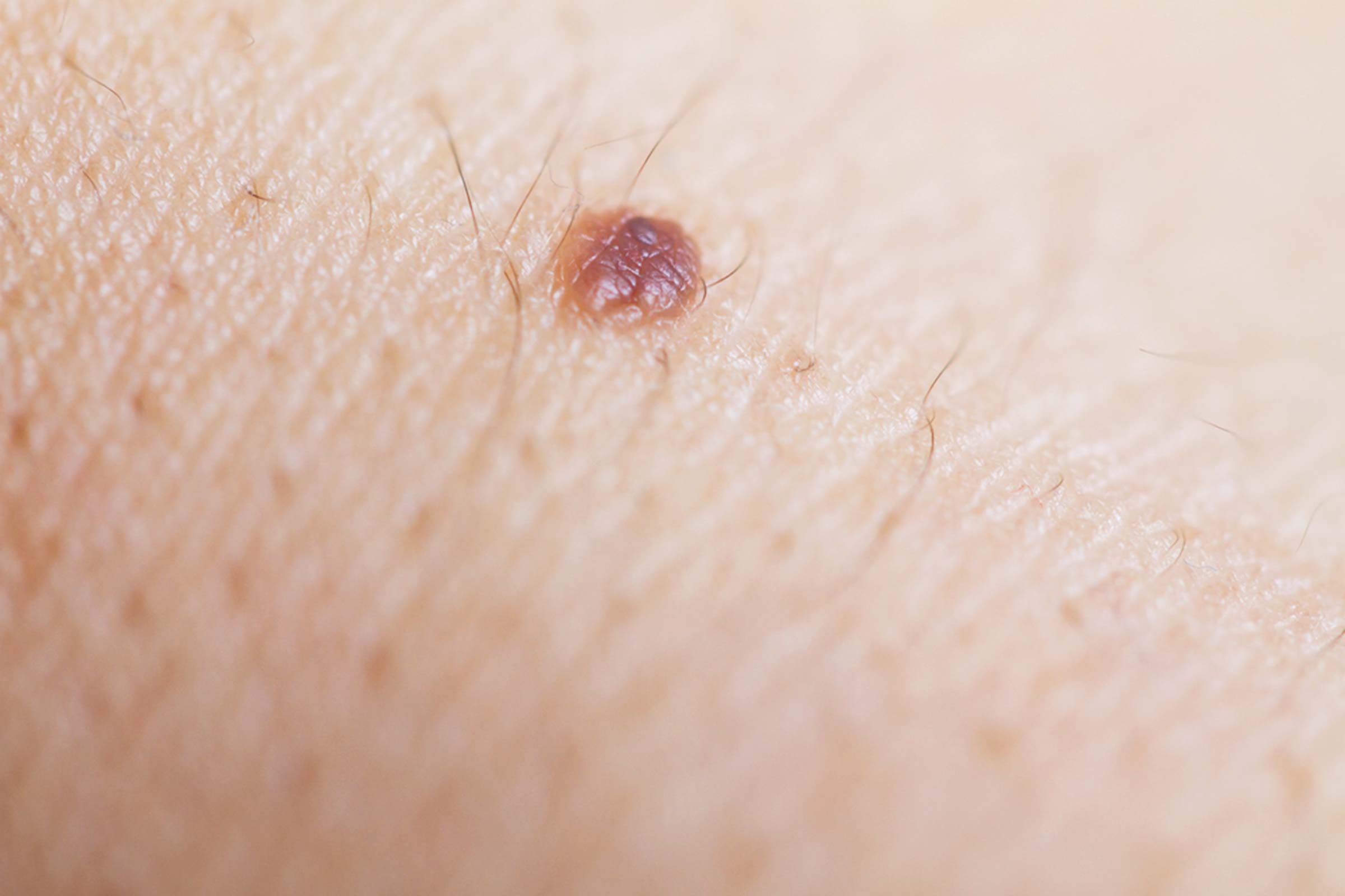 mole on skin