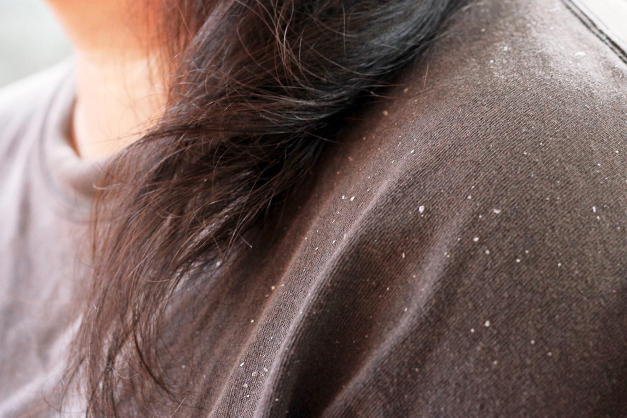 dandruff on shoulders of girl