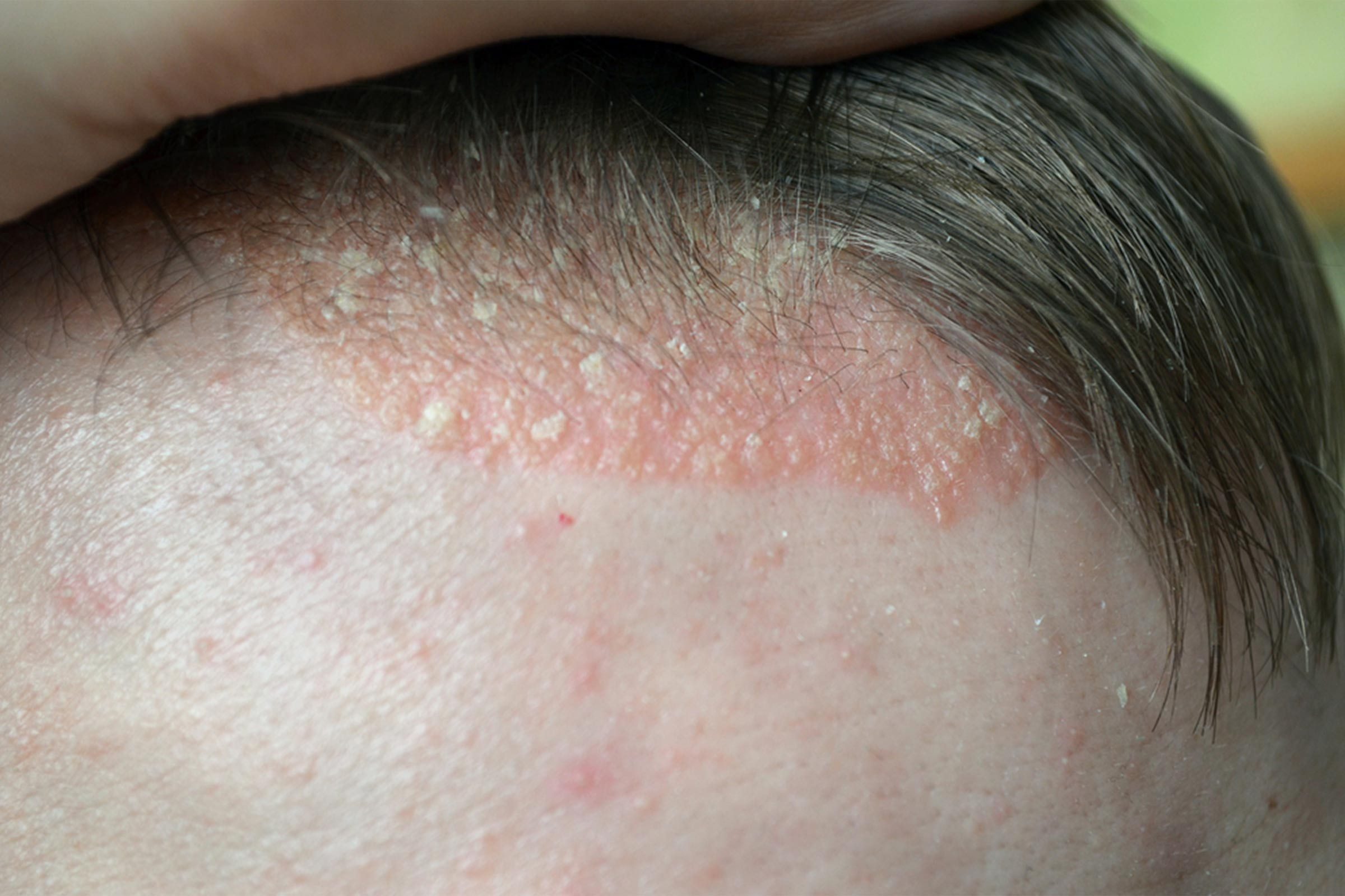 scalp with itchy looking eczema at hairline