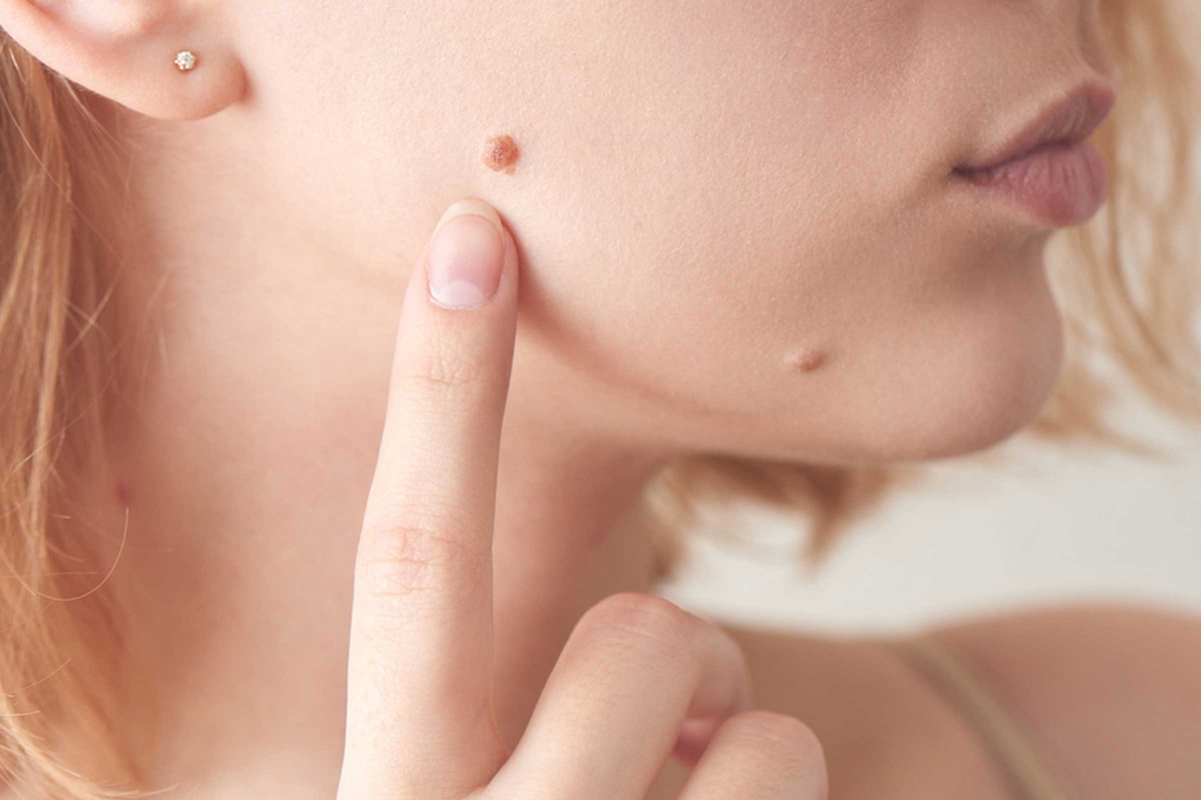 woman pointing to mole on her face