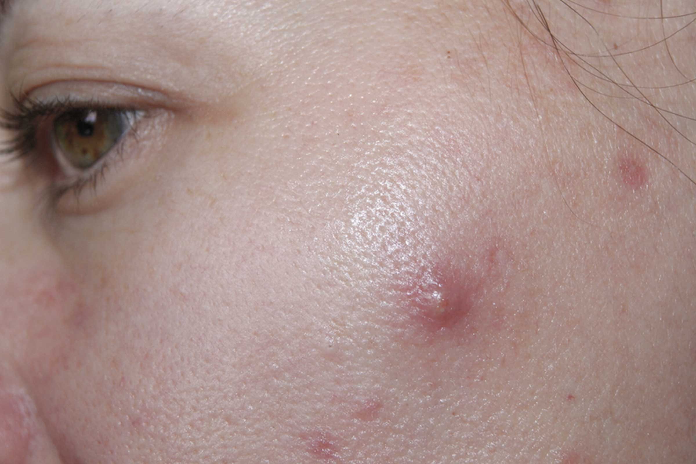 woman with cyst on her face