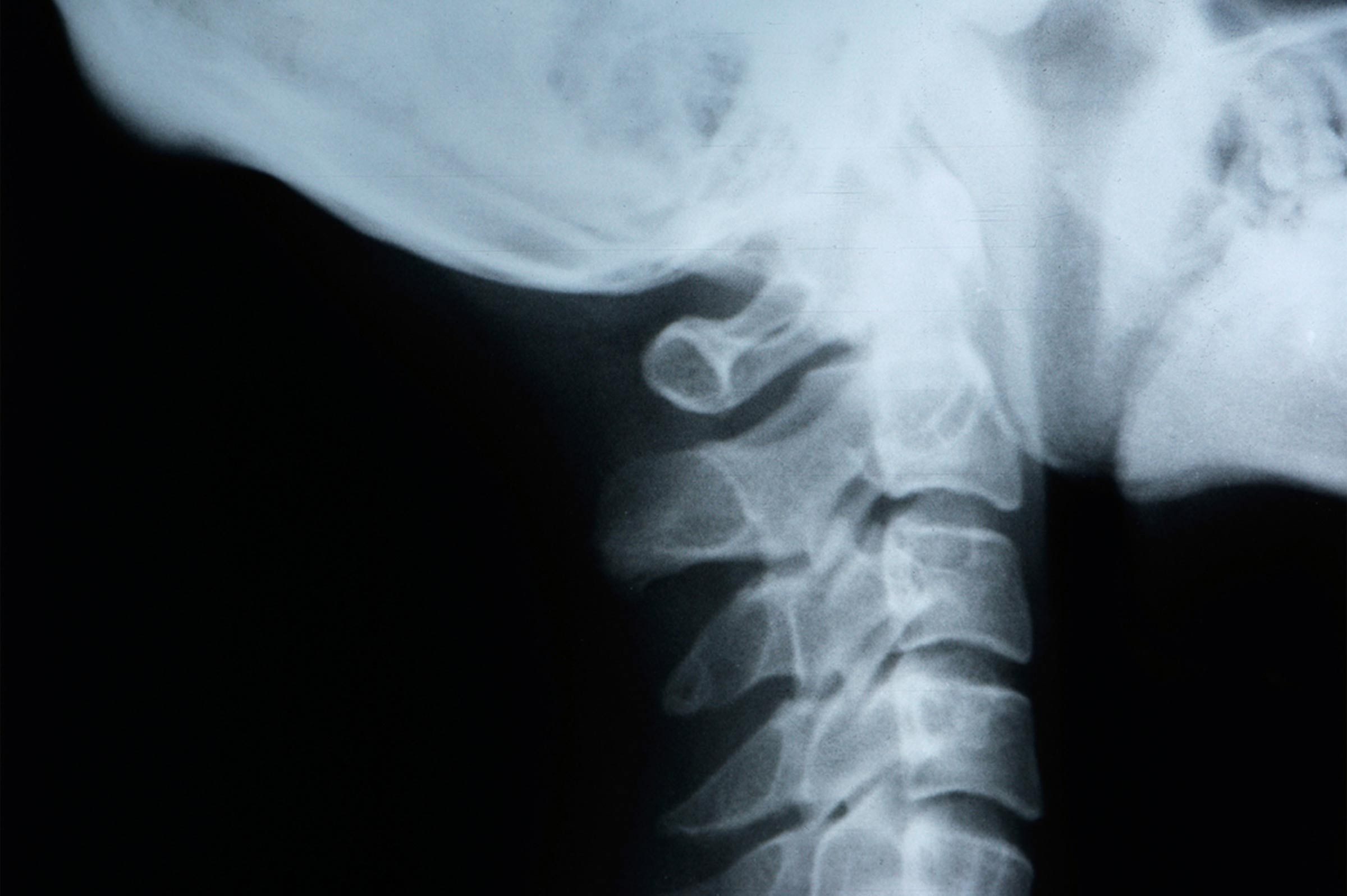 xray of bones in upper neck