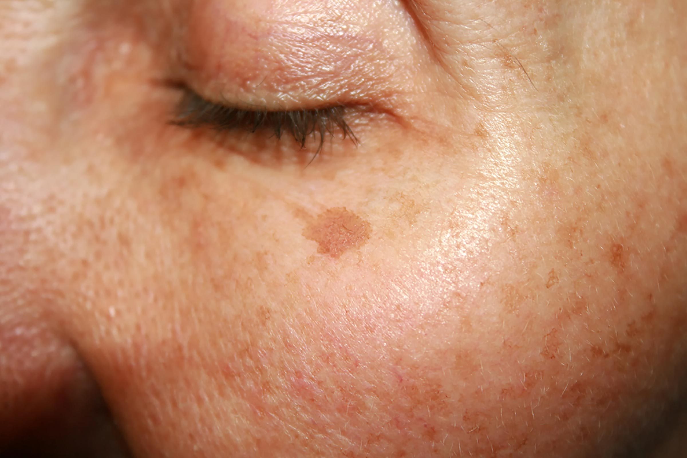 age spot under eye