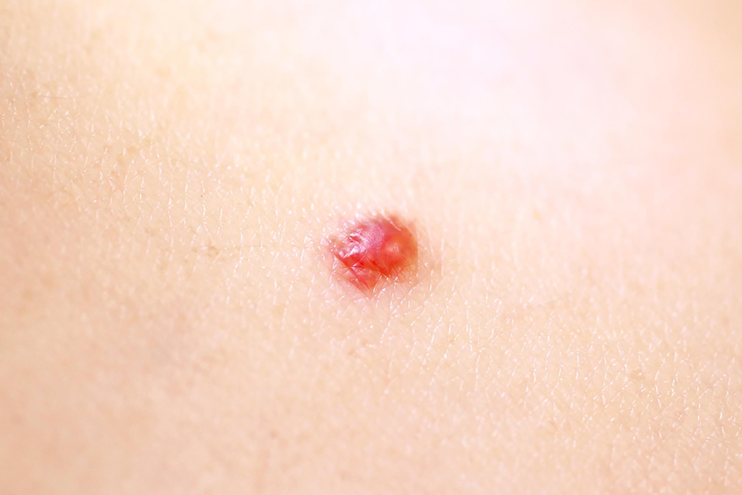 close up of a cherry angioma