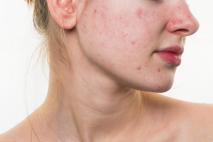 Woman with acne on her face