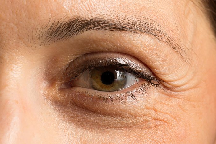 Closeup of a woman's under-eye dark circle.