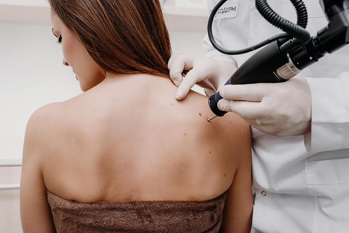 A woman getting skin tags removed by a dermatologist using a machine.