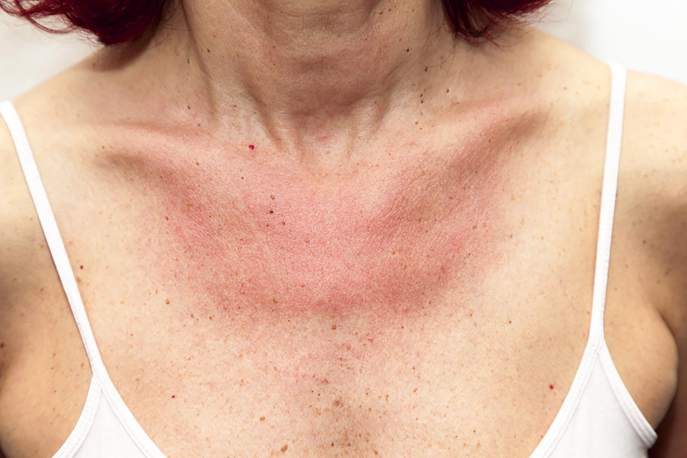woman in tank top with sunburned chest, freckles