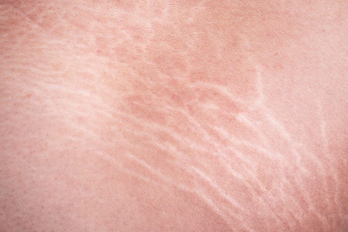 Closeup of stretch marks.