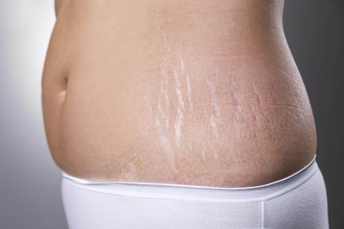 Stretch marks on tummy