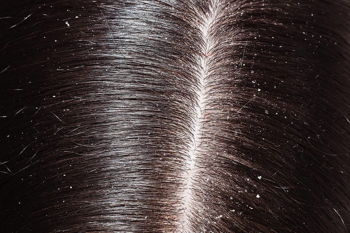 Dandruff along someone's hair part line.