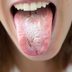 10 Natural Remedies for Thrush in the Mouth