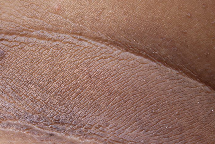 dark patches on skin