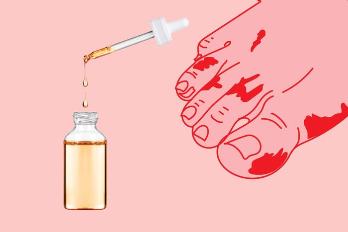 illustration of a foot with hotspots with photo of dropper and bottle