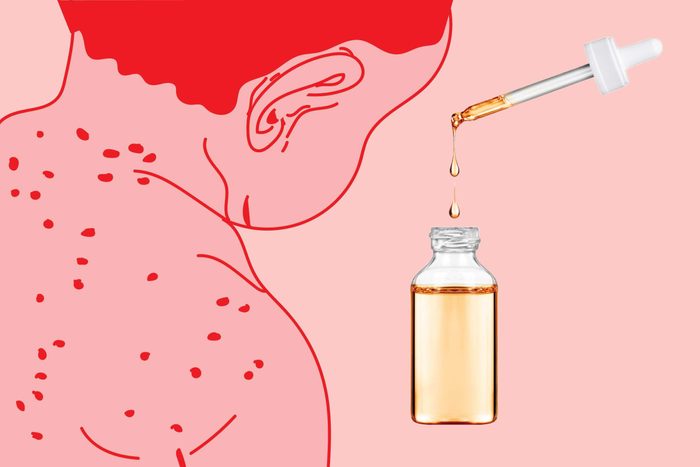 illustration of a child with chickenpox spots with photo of dropper and bottle