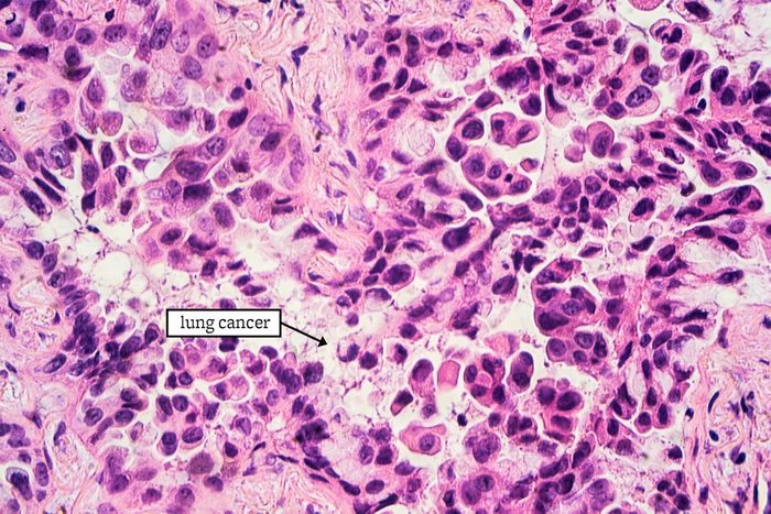 23 Groundbreaking Cancer Research That Could Save Your Life