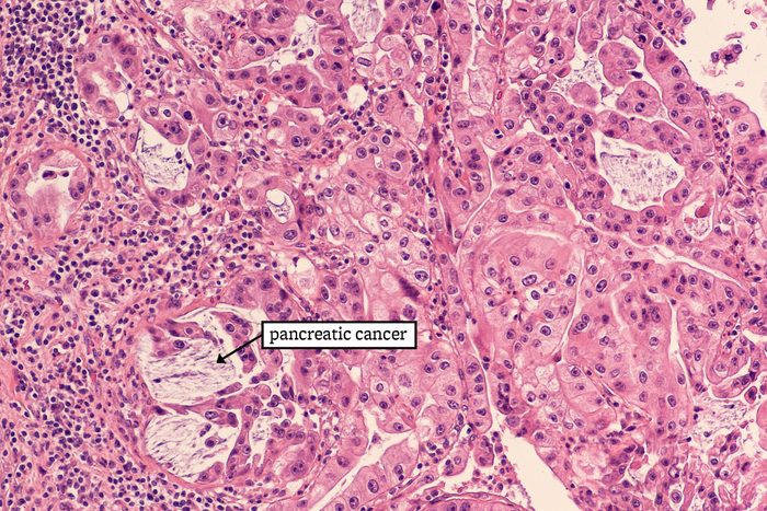 23 Groundbreaking Cancer Research That Could Save Your Life