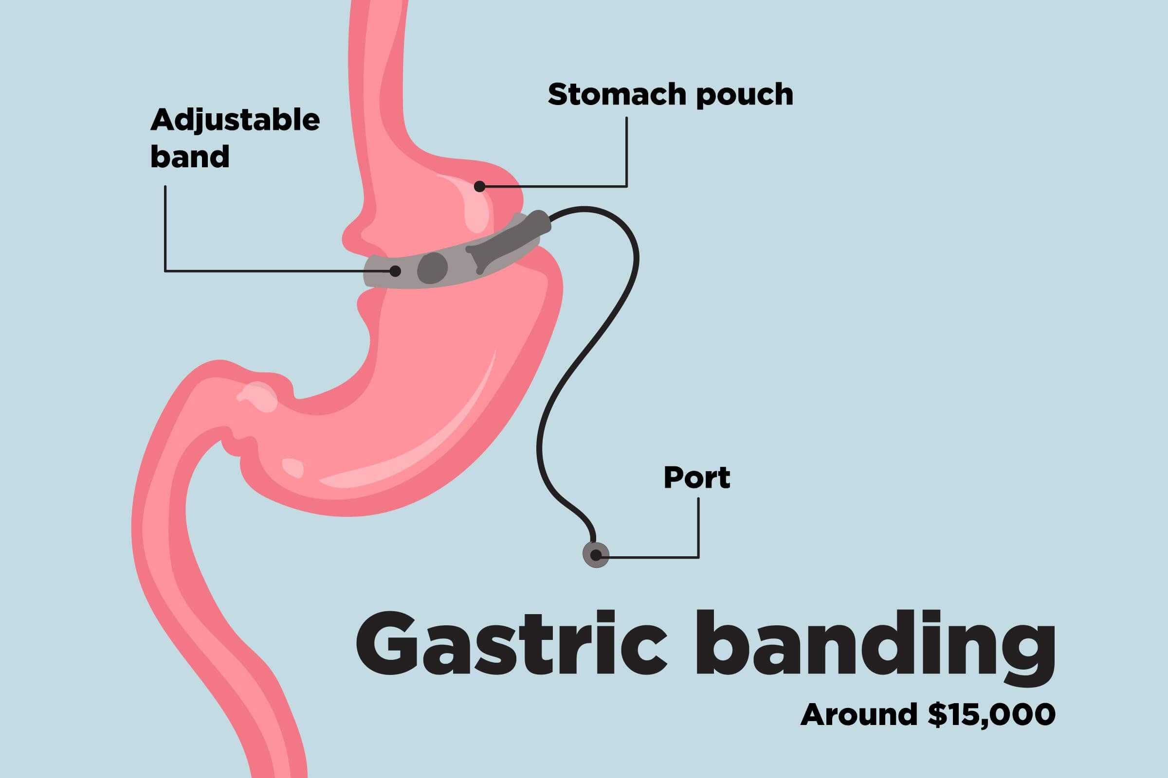 Top-Weight-Loss-Surgery-Procedures