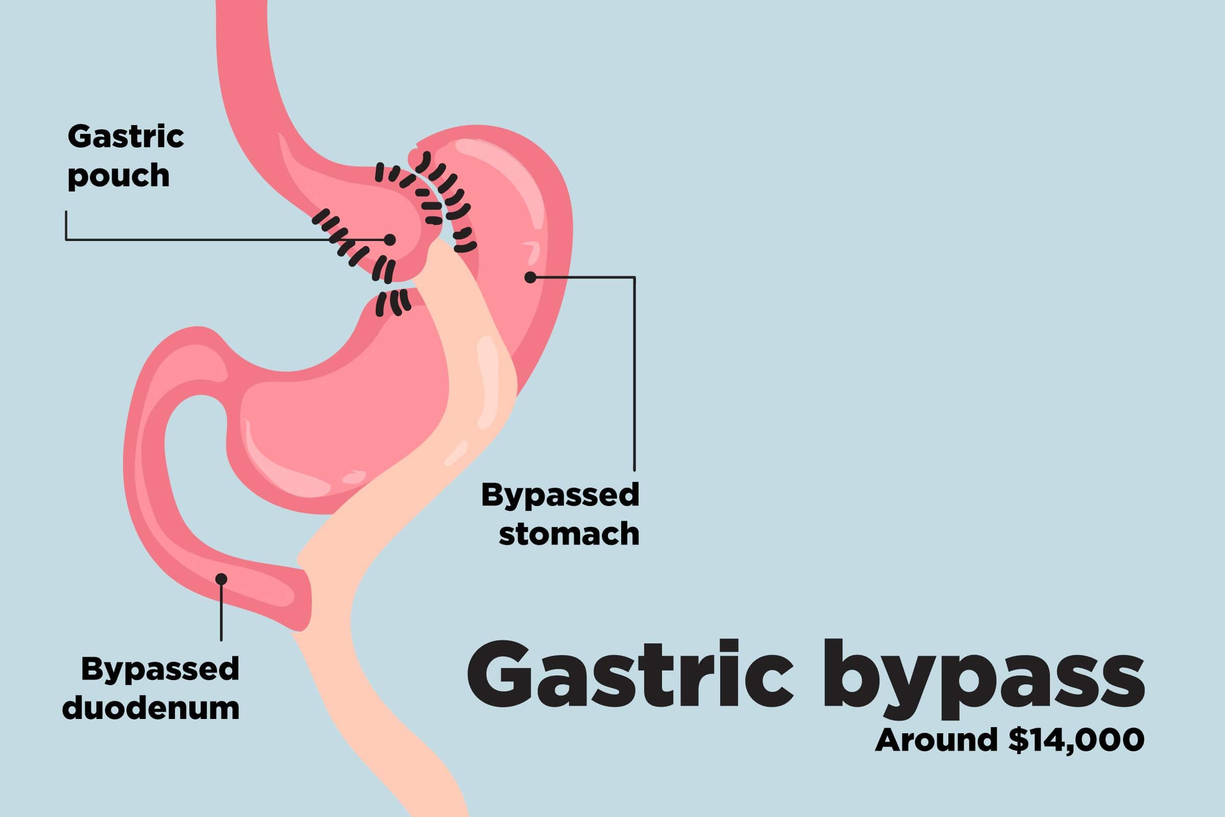 Top-Weight-Loss-Surgery-Procedures