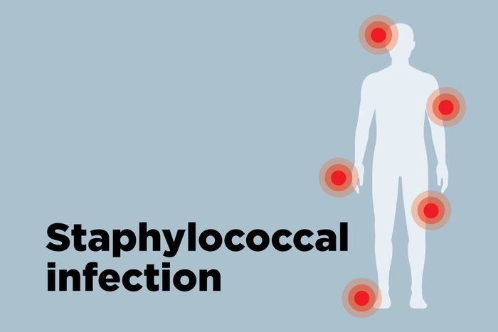 outline of body showing staph-infecton hotspots