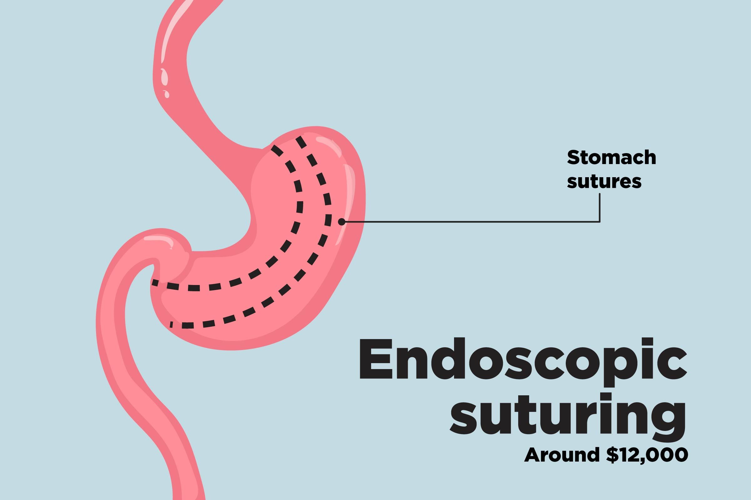 Top-Weight-Loss-Surgery-Procedures
