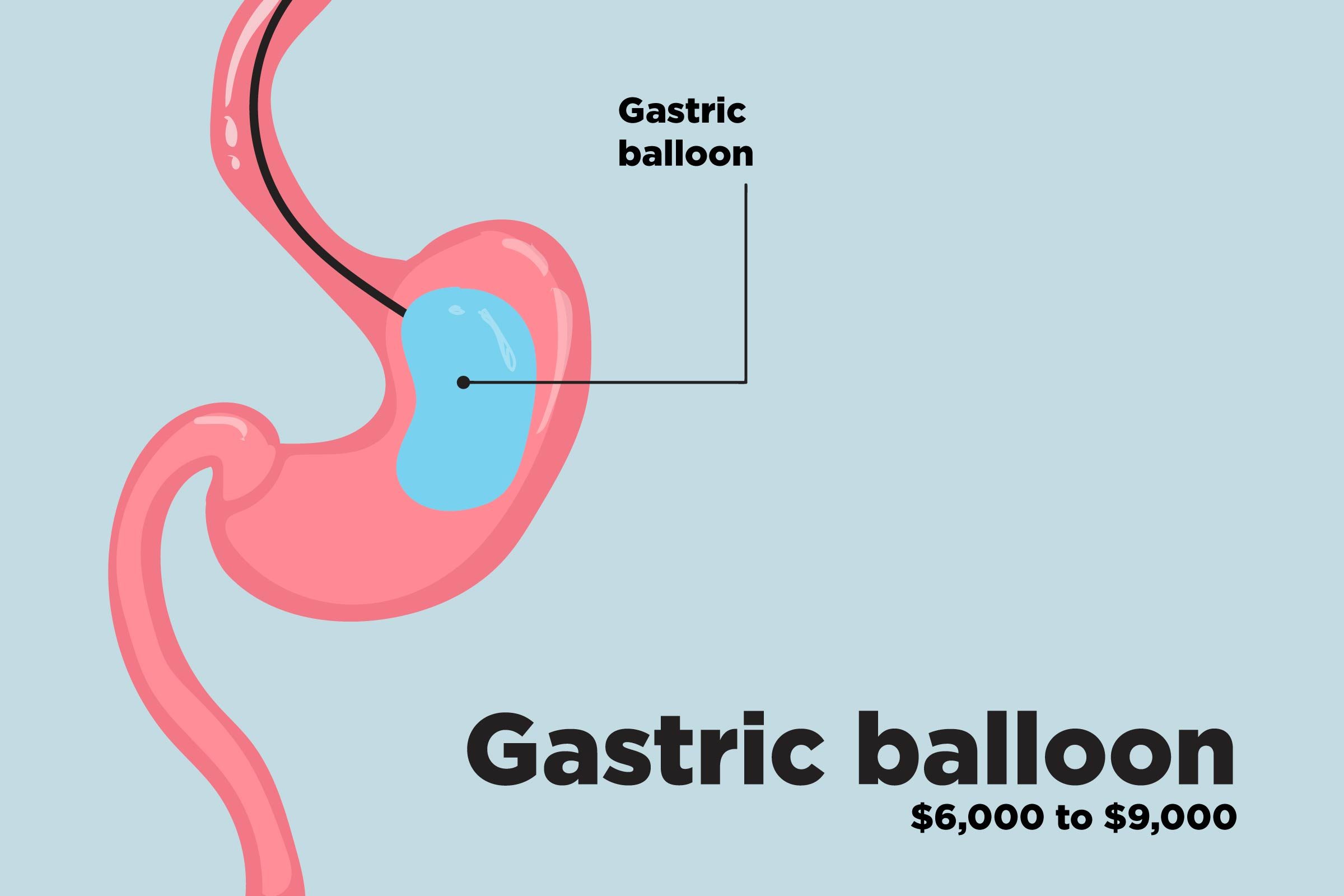 Top-Weight-Loss-Surgery-Procedures